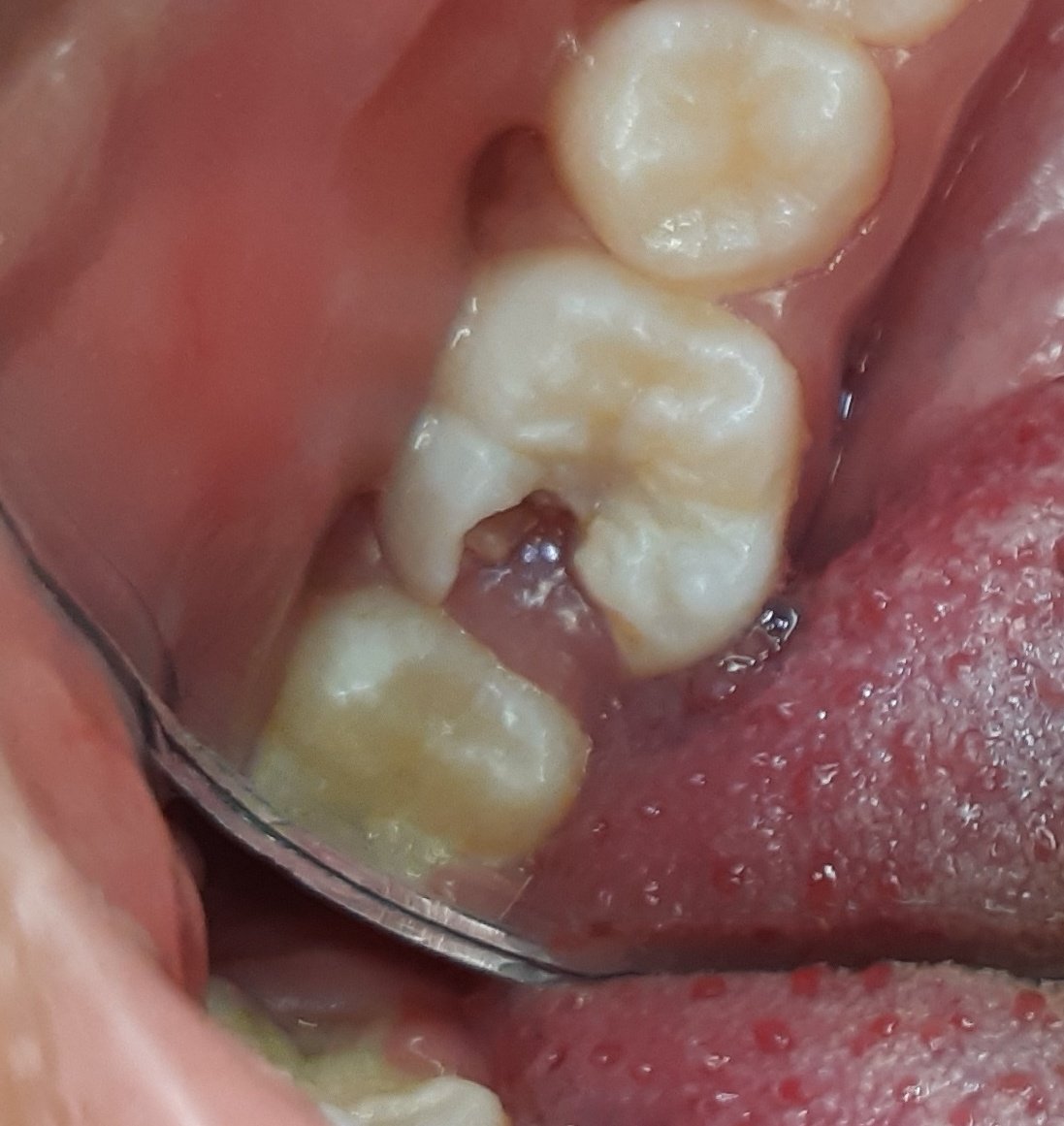 Daging Tumbuh Pada Gigi Berlubang - Victory Dental Care